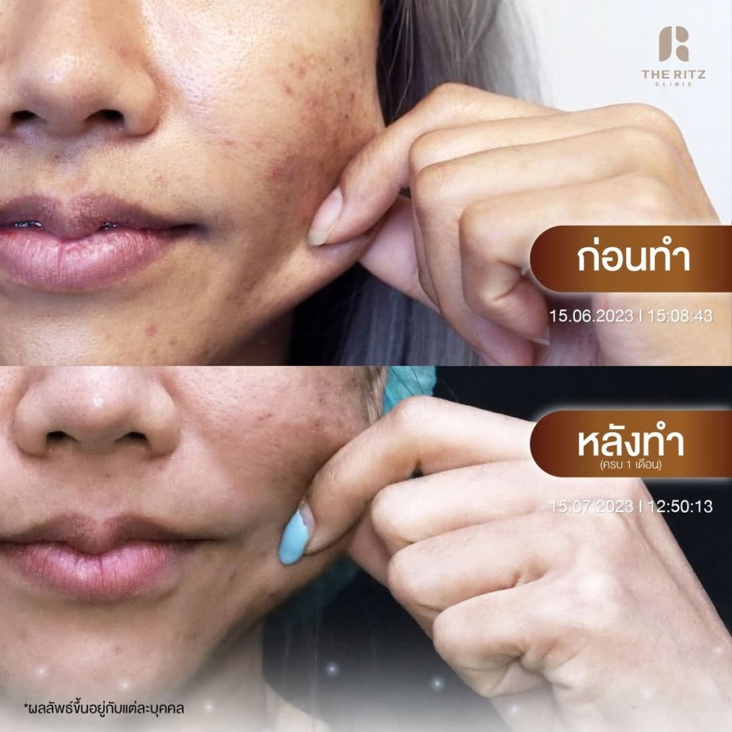 รีวิว Sculptra