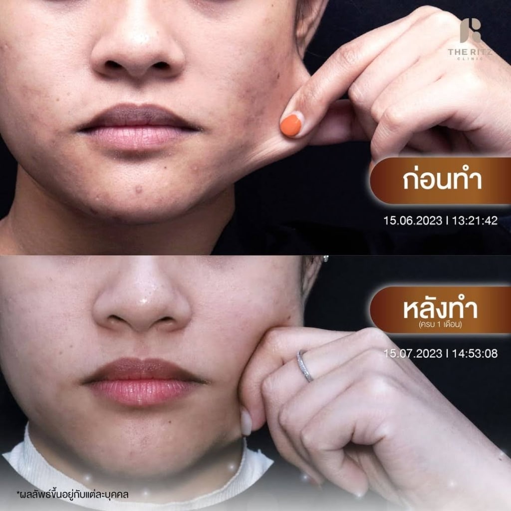 รีวิว Sculptra