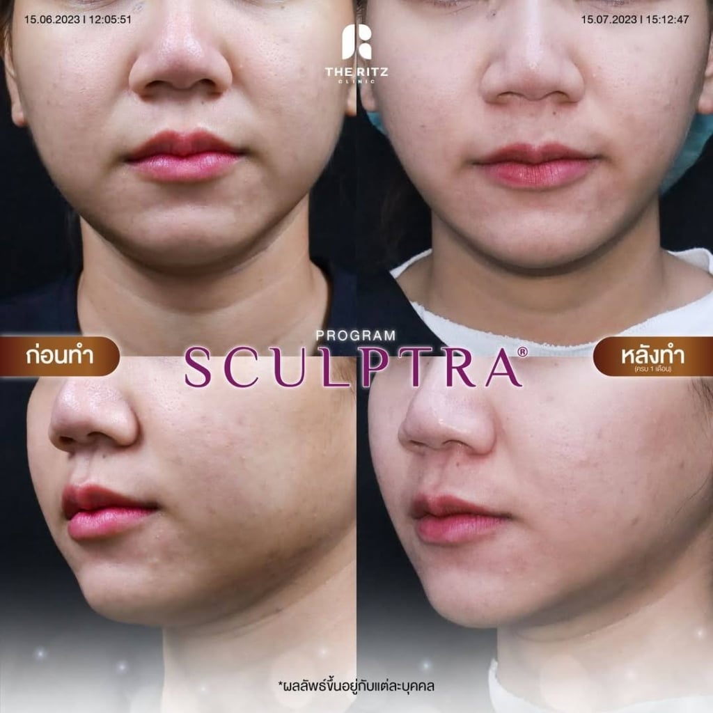 รีวิว Sculptra