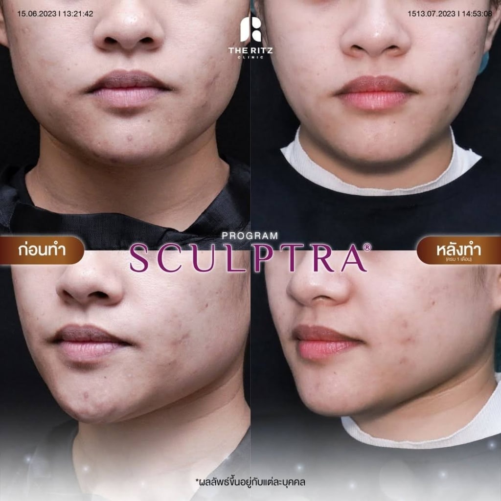 รีวิว Sculptra