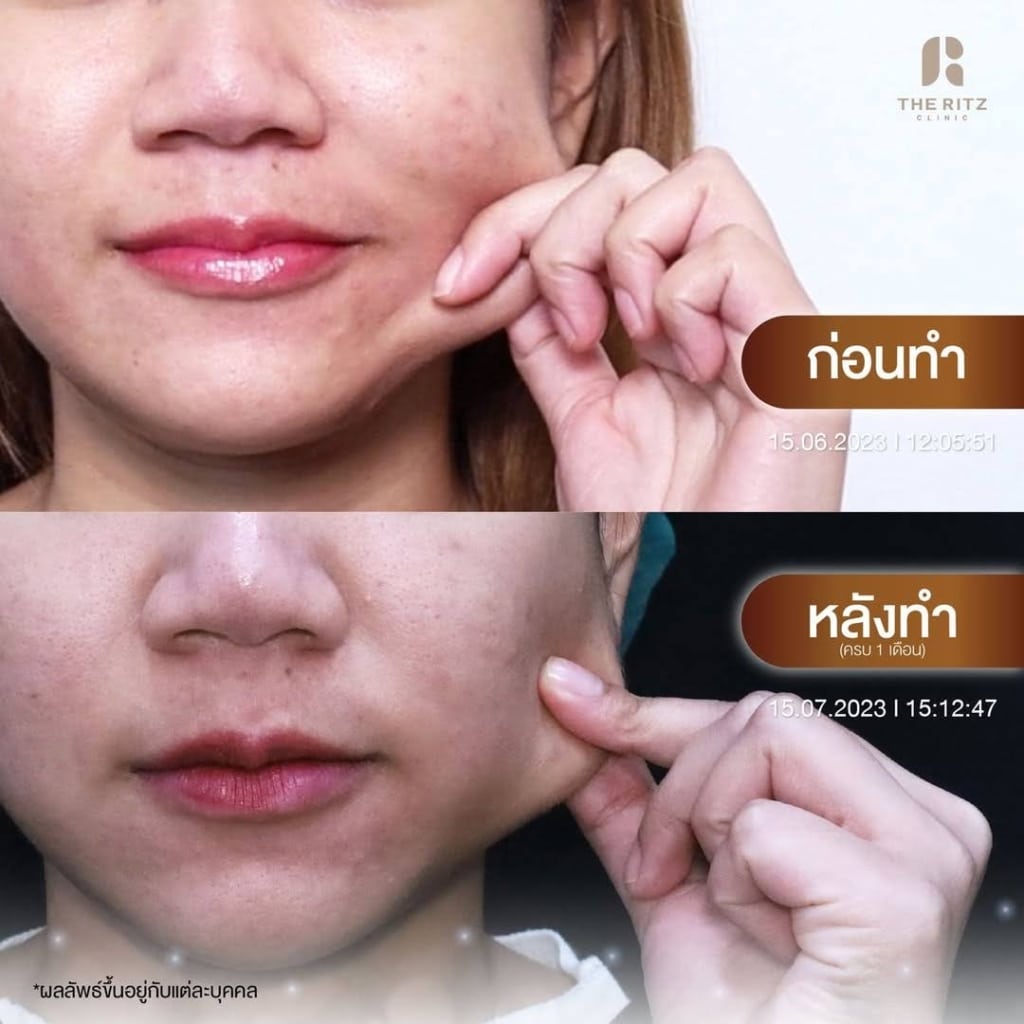 รีวิว Sculptra