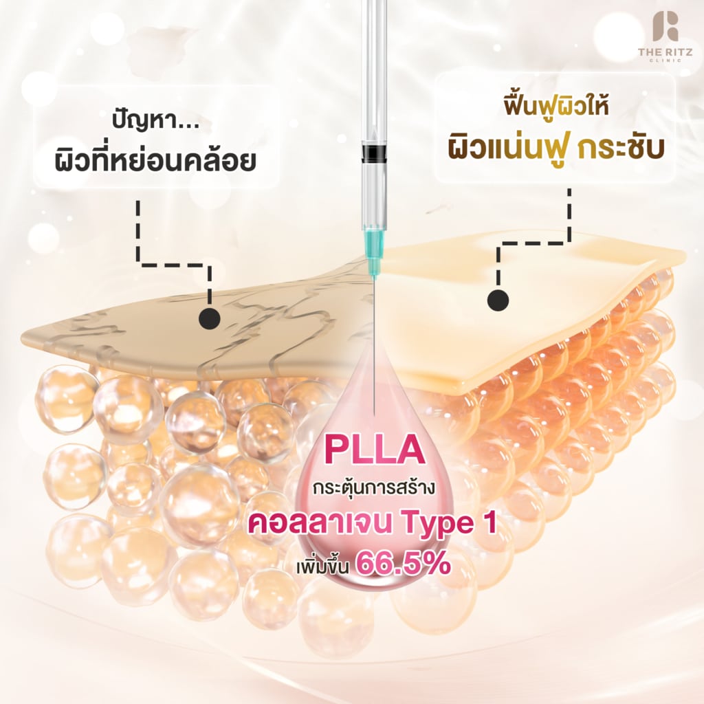 Sculptra ต้องฉีดกี่ครั้งถึงจะเห็นผล