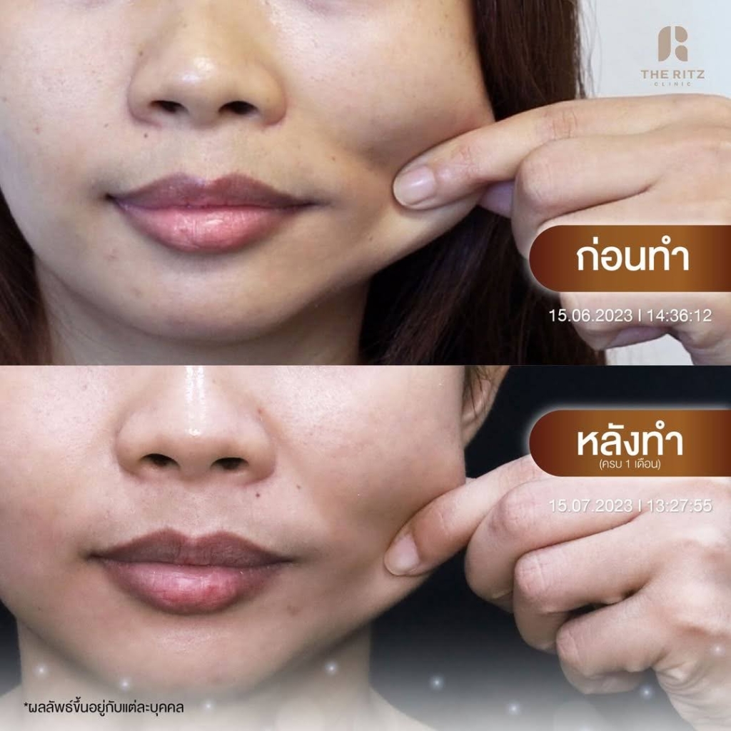รีวิว Sculptra