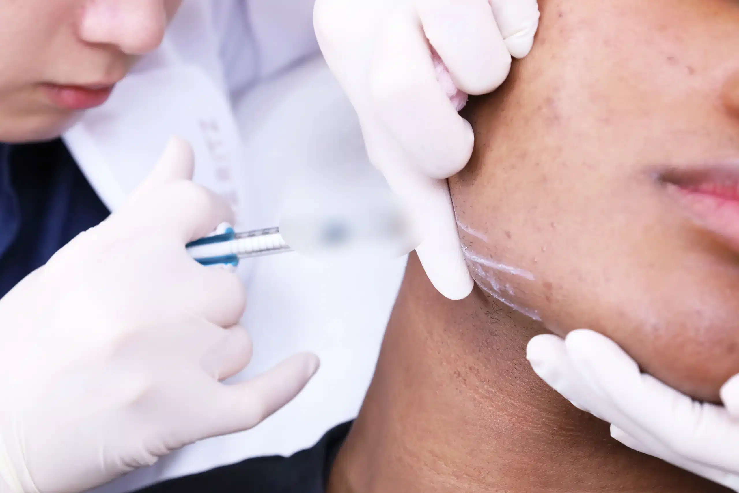 ฟิลเลอร์กรอบหน้า (Jawline Filler)