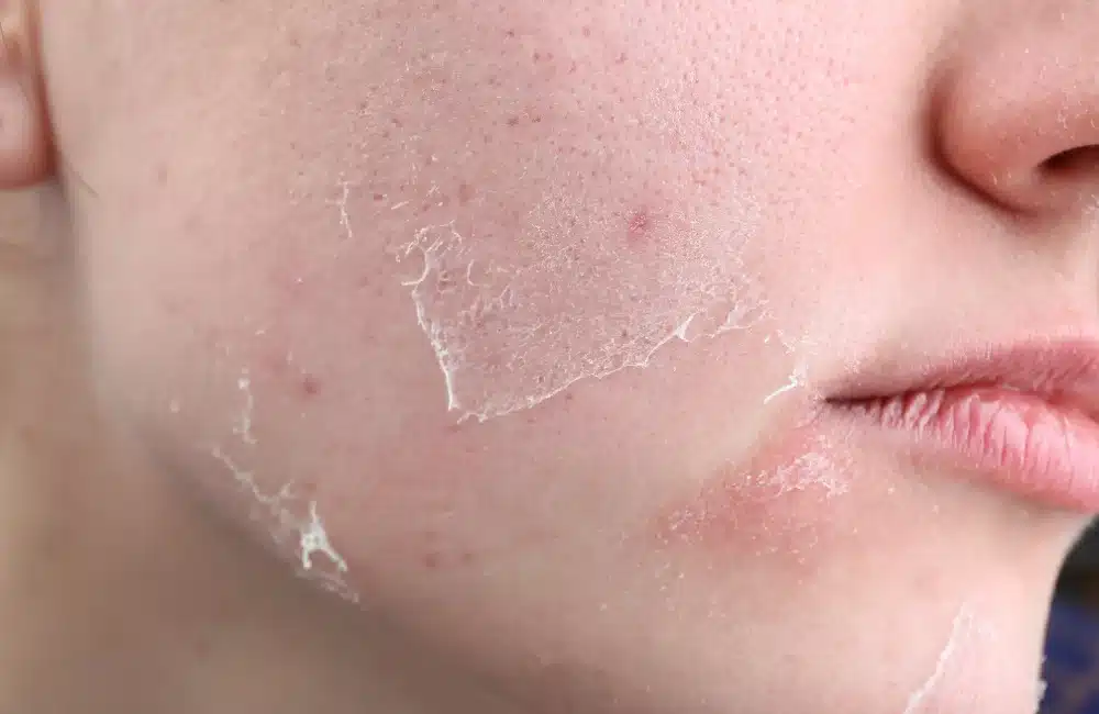 หน้าแห้ง