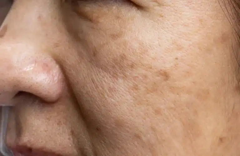 ฝ้าตื้น