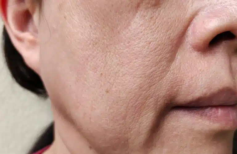 ผิวหย่อนคล้อ